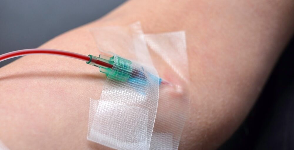Close-up of IV catheter taped to patient's arm used during ozone therapy immune system treatment session
