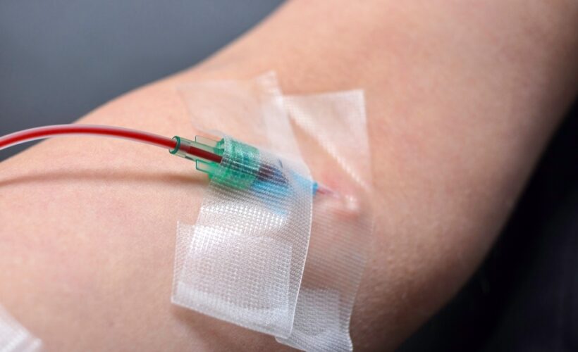 Close-up of IV catheter taped to patient's arm used during ozone therapy immune system treatment session