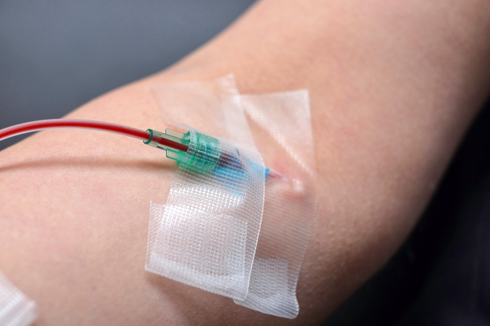 Close-up of IV catheter taped to patient's arm used during ozone therapy immune system treatment session